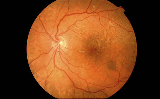 Retina - VERTE Oftalmología Barcelona