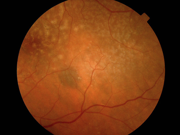 Retina - VERTE Oftalmología Barcelona