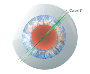 Cassini - Topografía - VERTE Oftalmología Barcelona