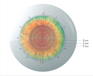 Cassini - Topografía - VERTE Oftalmología Barcelona