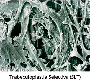 Trabeculoplastia Selectiva (SLT) - VERTE Oftalmología Barcelona