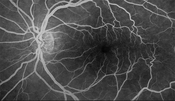 Angiografía con Fluoresceína - VERTE Oftalmología Barcelona