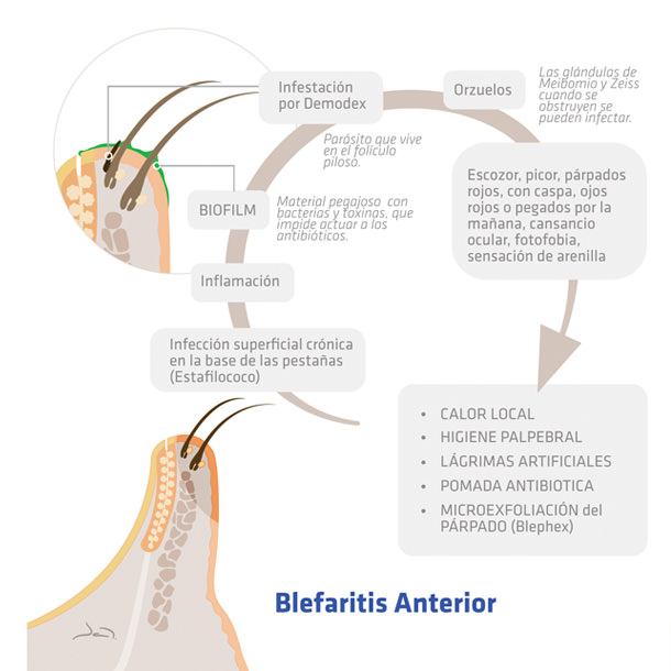 Blefaritis Anterior - VERTE Oftalmología Barcelona
