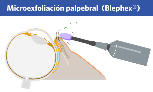 Blefaritis - Blephex - VERTE Oftalmología Barcelona