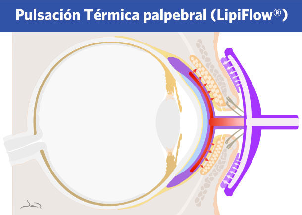 LipiFlow - Blefaritis - VERTE Oftalmología Barcelona