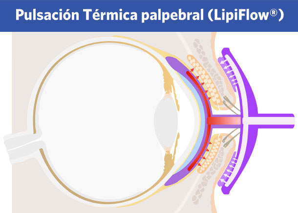 Blefaritis - Lipiflow - VERTE Oftalmología Barcelona