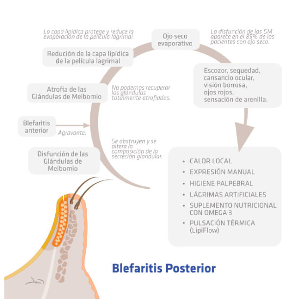 Blefaritis posterior - VERTE Oftalmología Barcelona