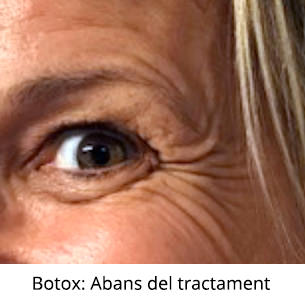 Botox Abans del tractament - VERTE Oftalmología Barcelona