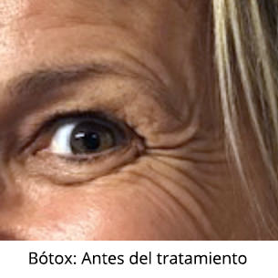 Antes - Bótox - Ojos - VERTE Oftalmología Barcelona