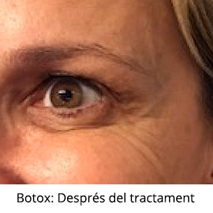Botox - Després del tractament - VERTE Oftalmología Barcelona