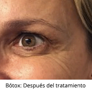 Después - Bótox - Ojos - VERTE Oftalmología Barcelona