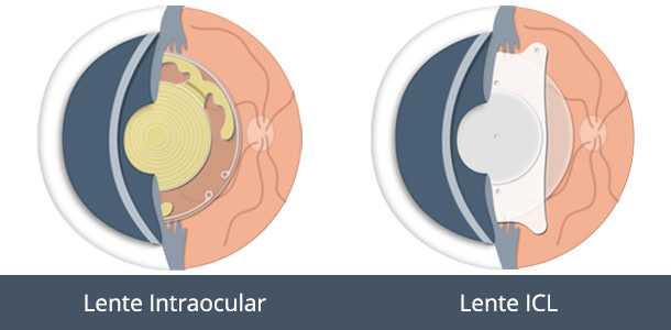Lentes Trifocales versus Lentes ICL - VERTE Oftalmología Barcelona
