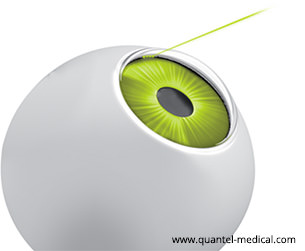Trabeculoplastia Láser Selectiva- Glaucoma - SLT- VERTE Oftalmología Barcelona