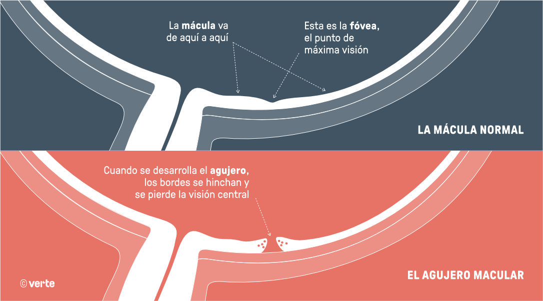 Agujero macular - Verte Oftalmología Barcelona