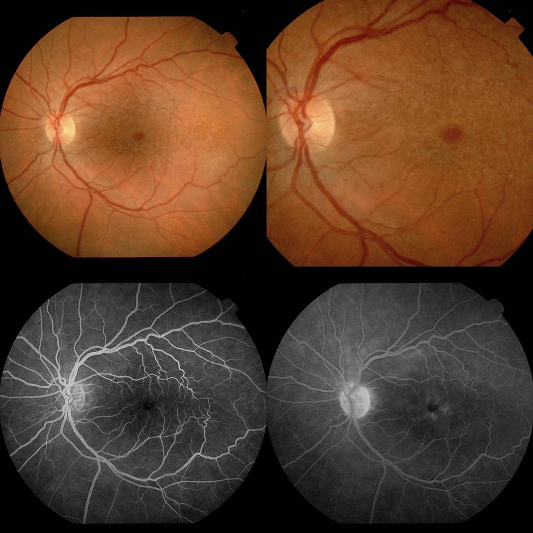 Membrana Epirretiniana - Angiografía con Fluoresceína (AGF)