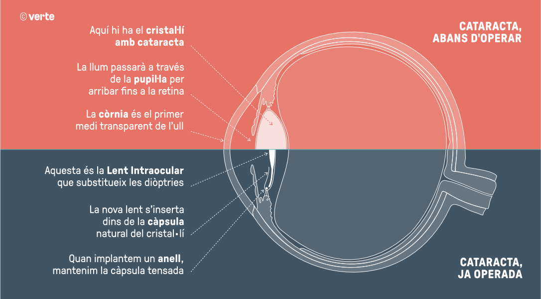 Operació de cataractes - VERTE Oftalmologia Barcelona