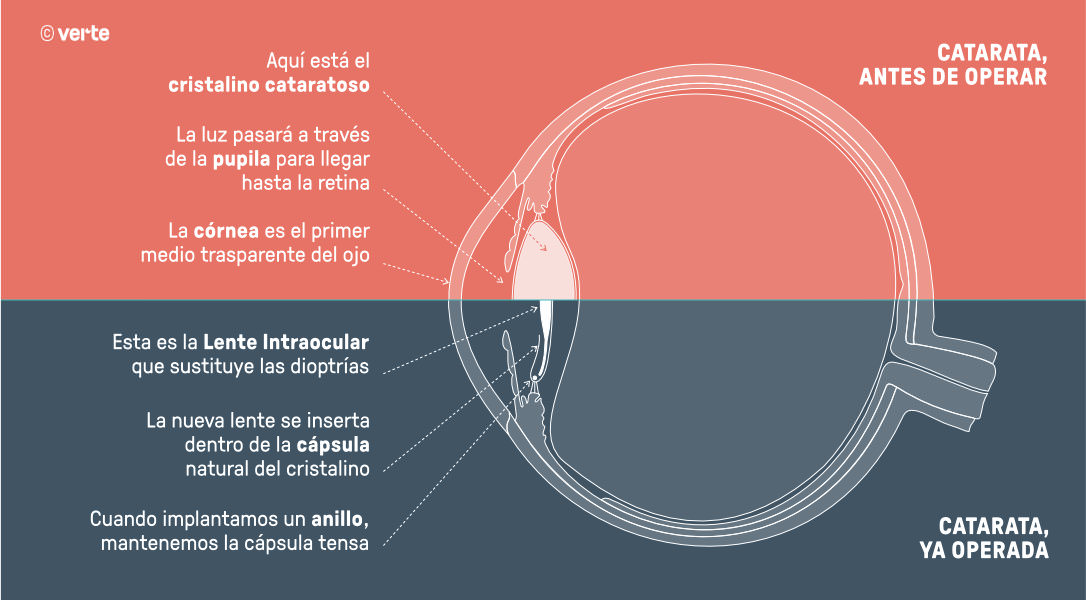 Operación de cataratas - VERTE Oftalmología Barcelona