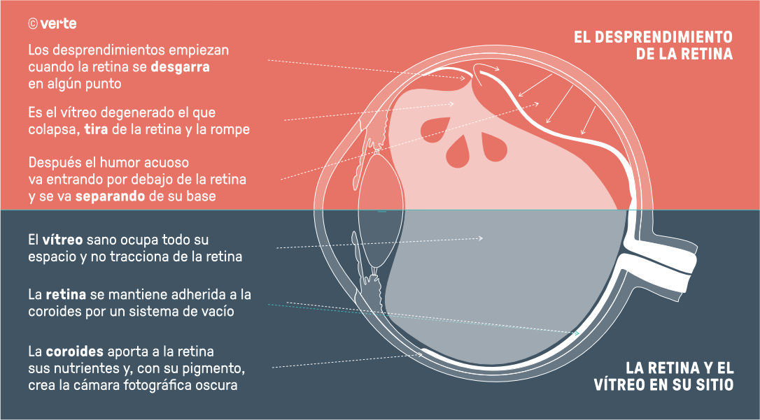 Operación desprendimiento de retina - VERTE Oftalmología Barcelona