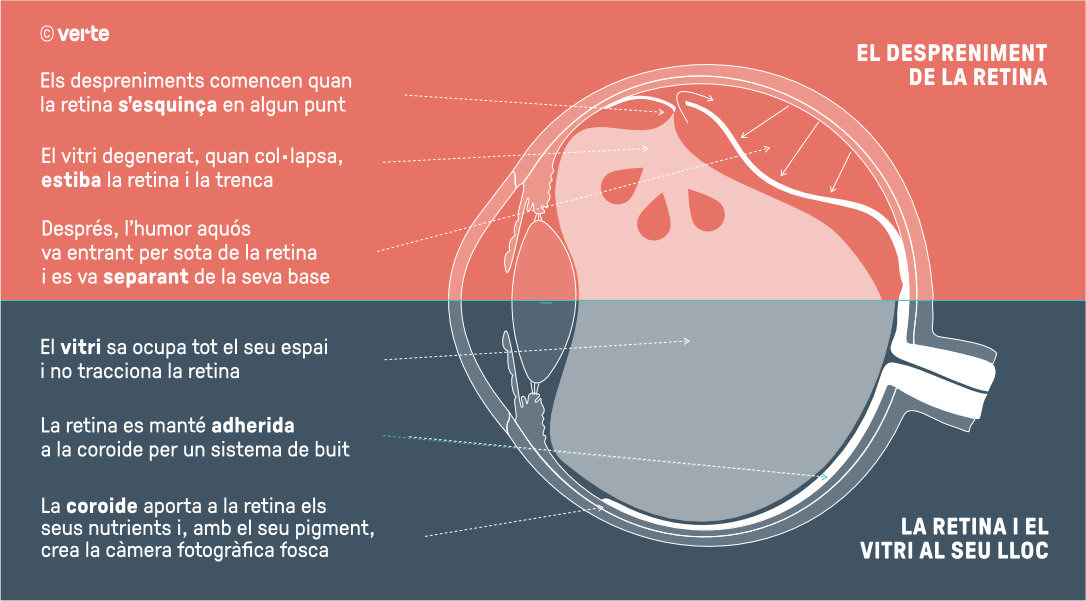 Operació despreniment de retina - VERTE Oftalmologia Barcelona