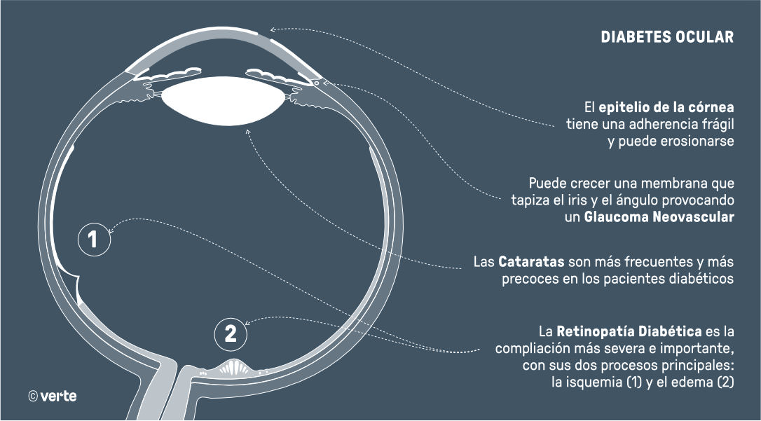 Diabetes ocular - VERTE Oftalmología Barcelona