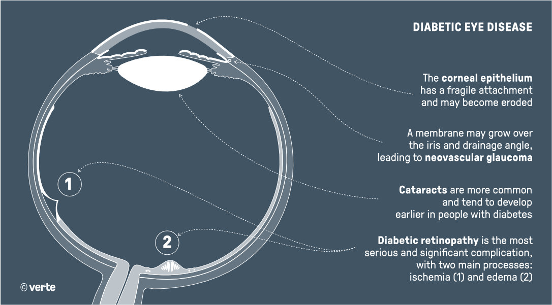 Diabetic eye disease - VERTE Ophthalmology Barcelona