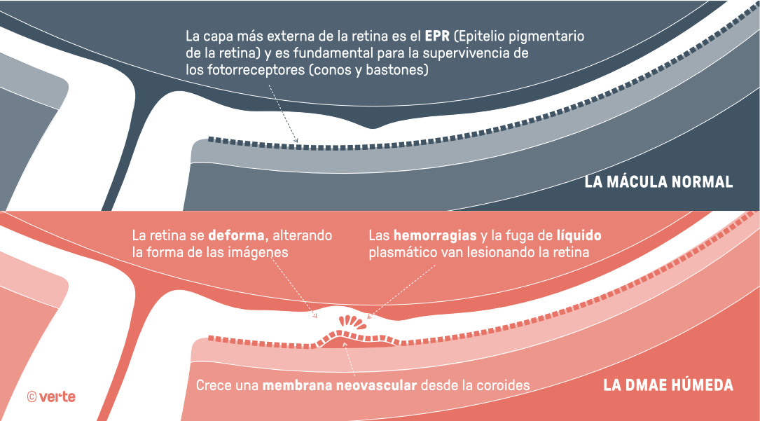 DMAE húmeda - Verte Oftalmología Barcelona