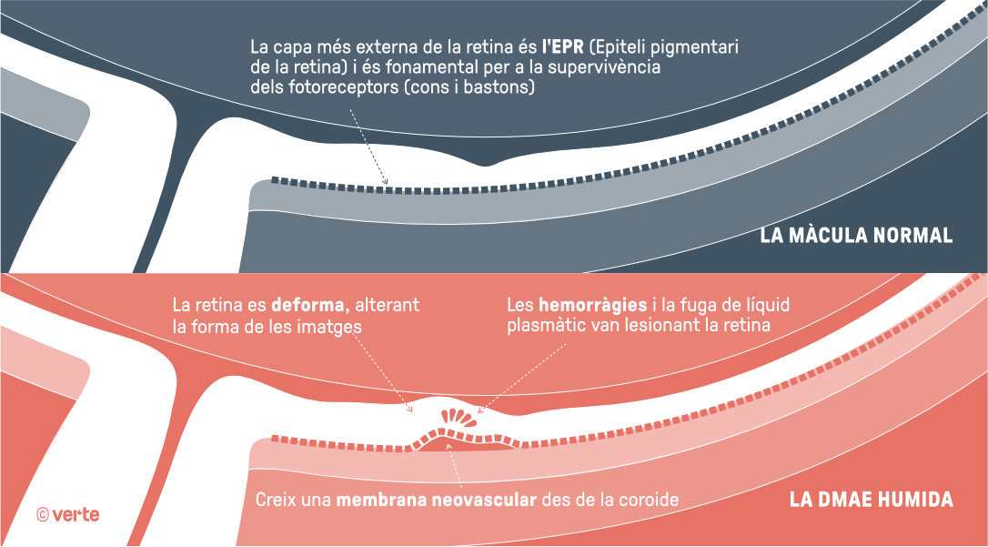 DMAE humida - Verte Oftalmologia Barcelona