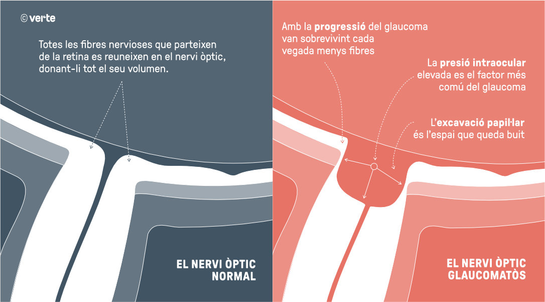 Glaucoma Crònic - Tractament - VERTE Oftalmologia Barcelona