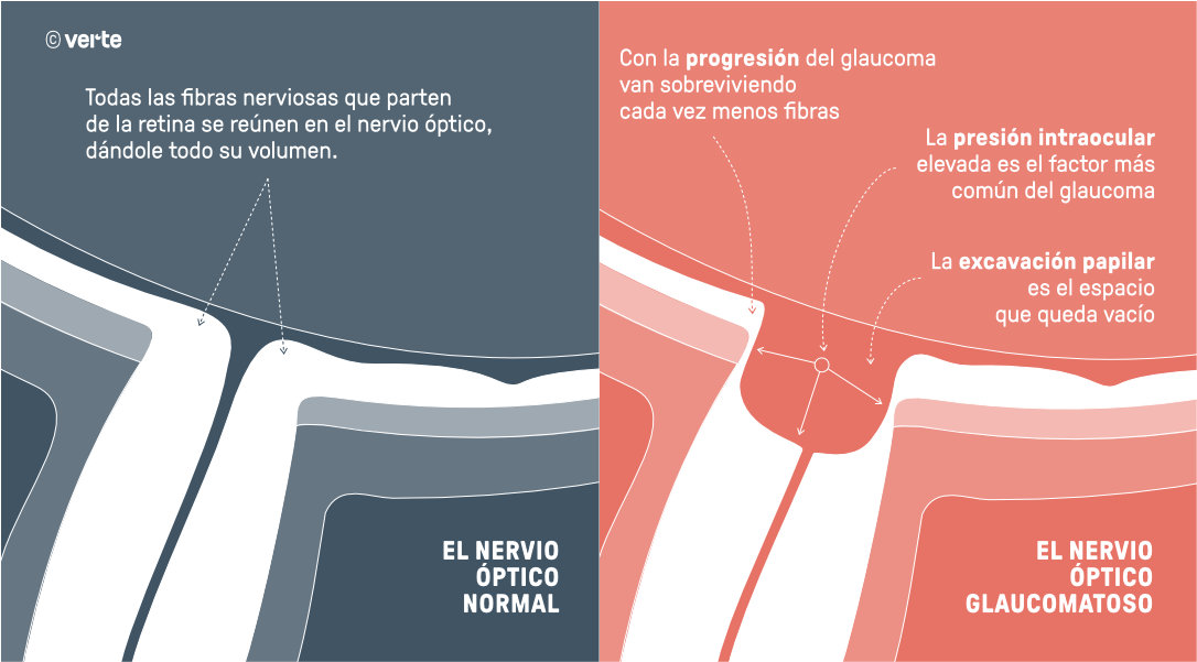 Glaucoma Crónico - Tratamiento - VERTE Oftalmología Barcelona