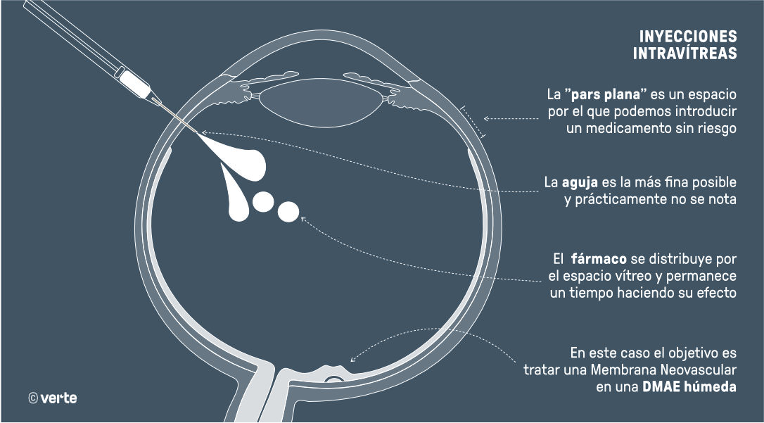 Inyecciones Intravítreas - VERTE Oftalmología Barcelona