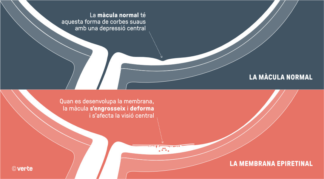 Membrana Epiretinal- VERTE Oftalmologia Barcelona