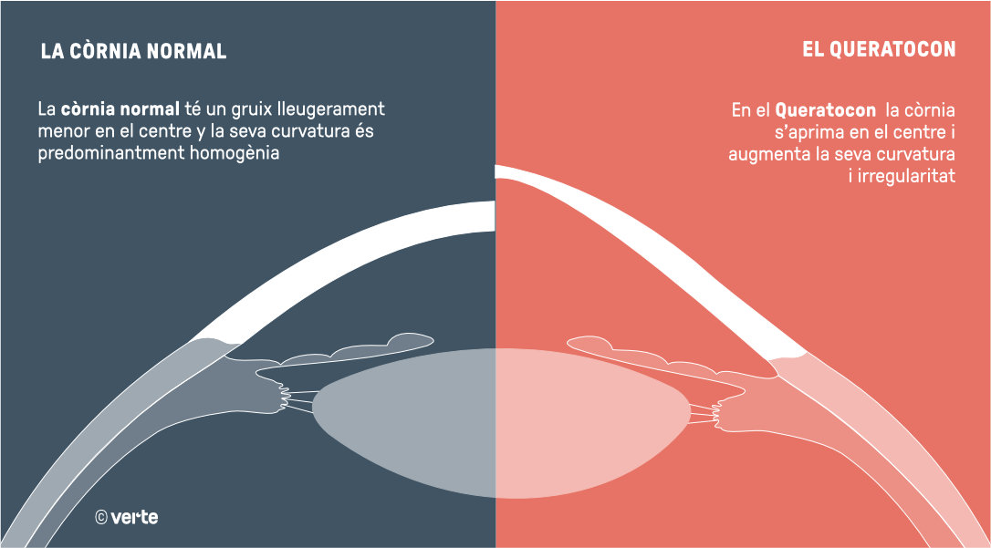 Quereatocon - VERTE Oftalmologia Barcelona