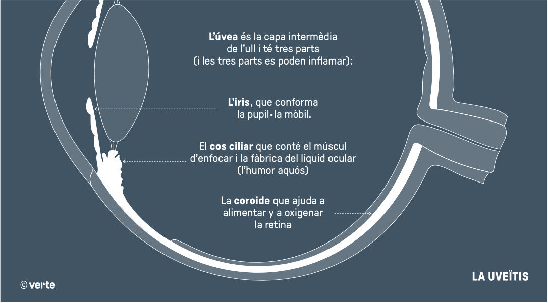 Uveïtis - VERTE Oftalmologia Barcelona