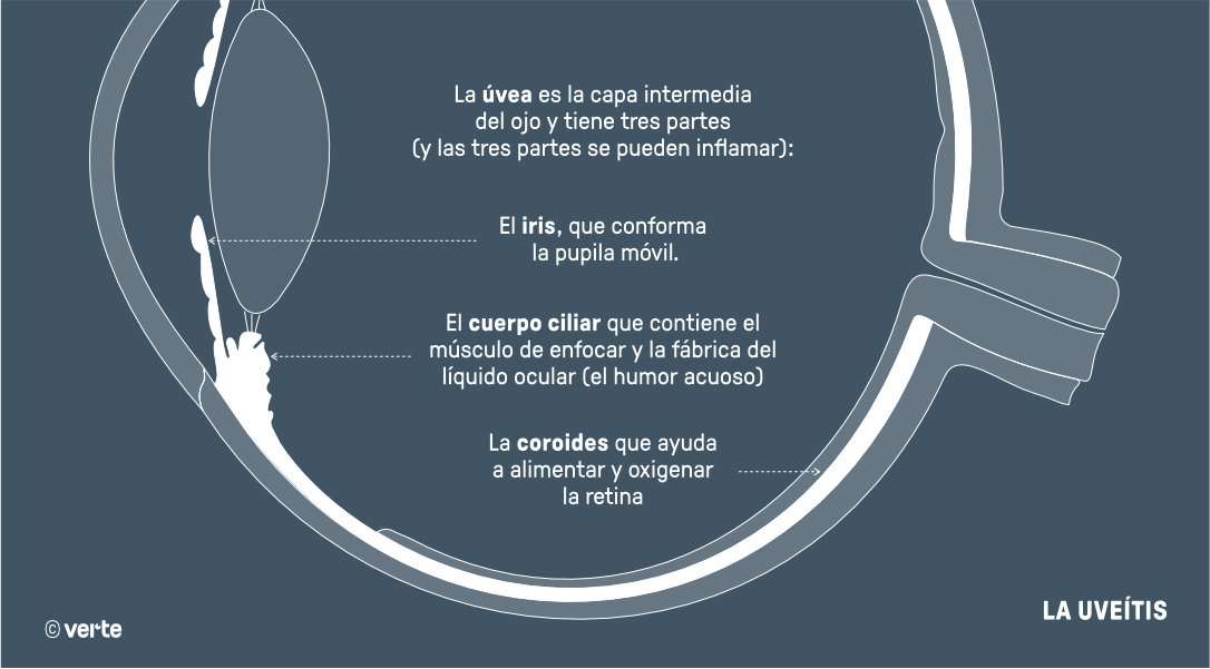 Uveítis - VERTE Oftalmología Barcelona