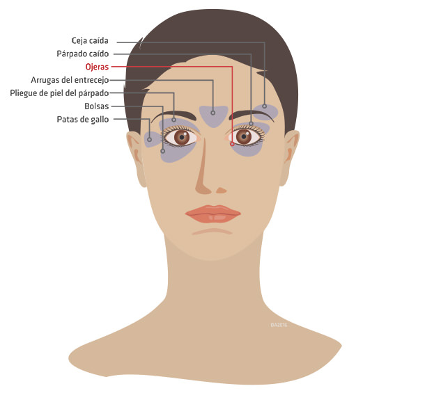 Cirugia plastica ocular - Párpados caídos - VERTE Oftalmología Barcelona